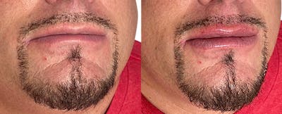 Lip Enhancement Before & After Gallery - Patient 366048 - Image 1