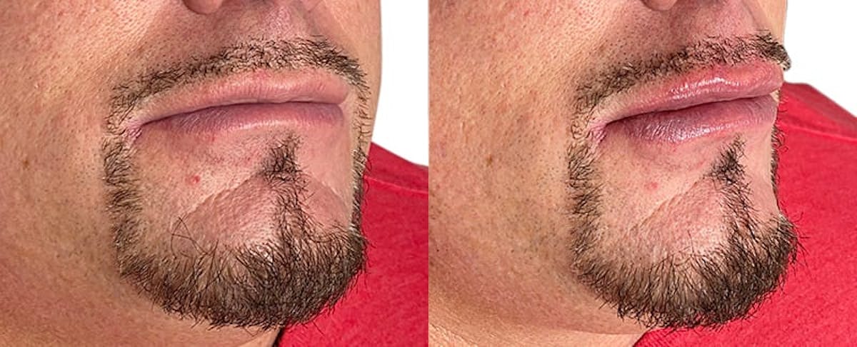 Lip Enhancement Before & After Gallery - Patient 366048 - Image 2