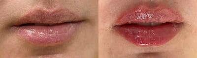 Lip Enhancement Before & After Gallery - Patient 280493 - Image 1