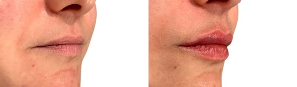 Lip Enhancement Before & After Gallery - Patient 161667 - Image 2