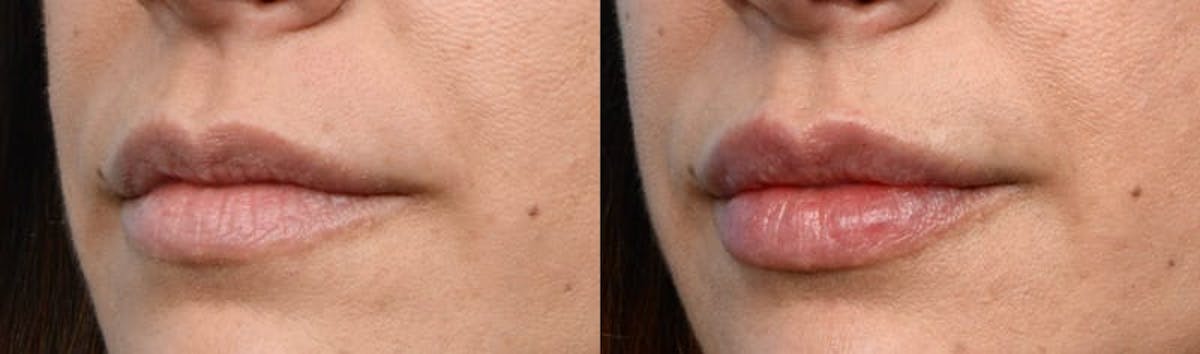 Lip Enhancement Before & After Gallery - Patient 422809 - Image 1