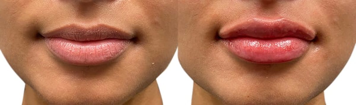 Lip Enhancement Before & After Gallery - Patient 312893 - Image 1