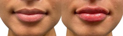 Lip Enhancement Before & After Gallery - Patient 246901 - Image 1