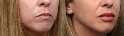 Lip Enhancement Before & After Gallery - Patient 272092 - Image 1