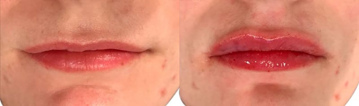Lip Enhancement Before & After Gallery - Patient 223137 - Image 1