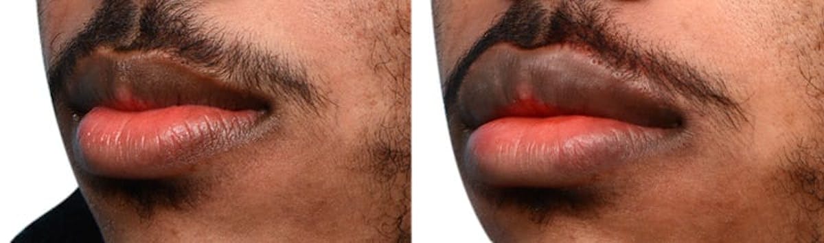 Lip Enhancement Before & After Gallery - Patient 166087 - Image 2