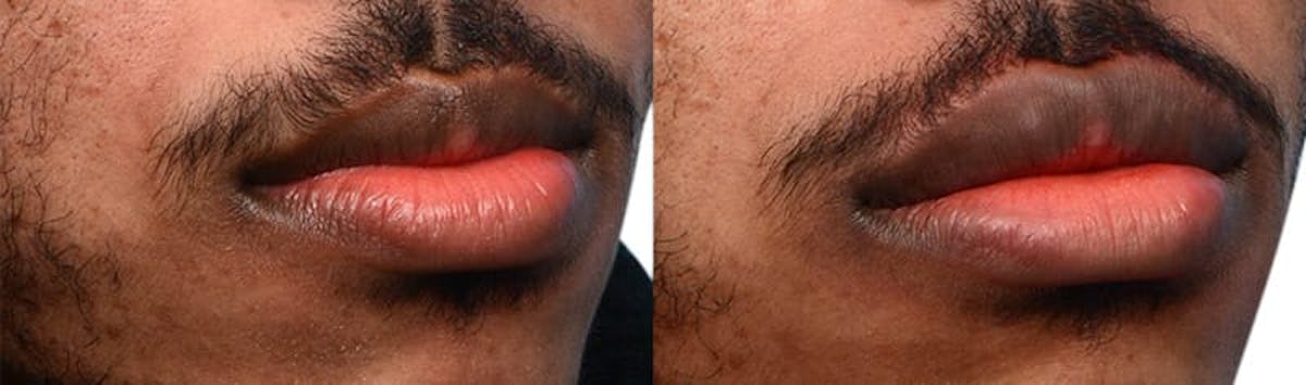 Lip Enhancement Before & After Gallery - Patient 166087 - Image 3
