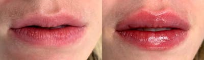 Lip Enhancement Before & After Gallery - Patient 425850 - Image 1