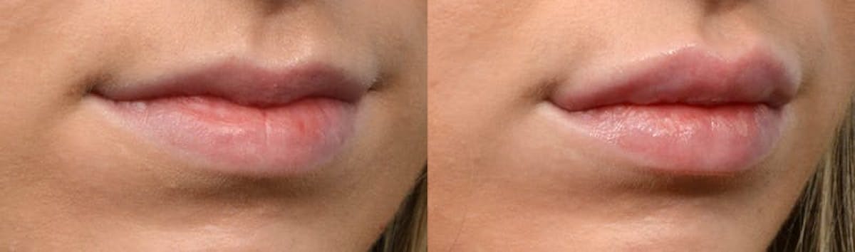 Lip Enhancement Before & After Gallery - Patient 425850 - Image 2