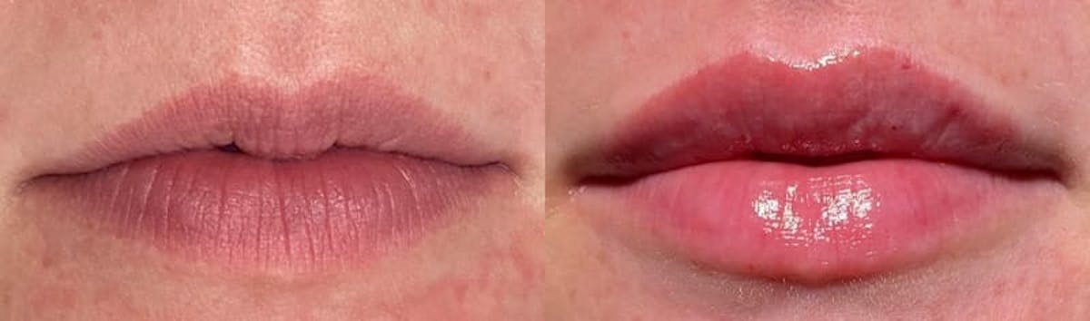 Lip Enhancement Before & After Gallery - Patient 326513 - Image 1