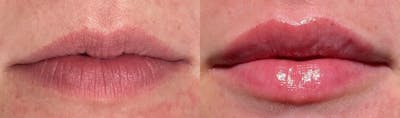 Lip Enhancement Before & After Gallery - Patient 326513 - Image 1