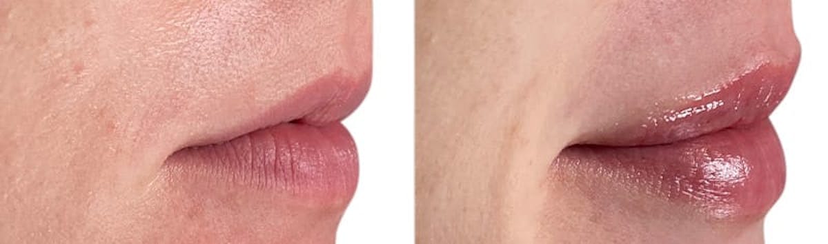 Lip Enhancement Before & After Gallery - Patient 326513 - Image 2