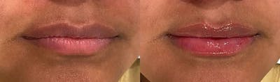 Lip Enhancement Before & After Gallery - Patient 114829 - Image 1