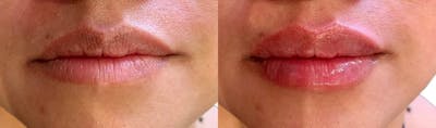 Lip Enhancement Before & After Gallery - Patient 330790 - Image 1