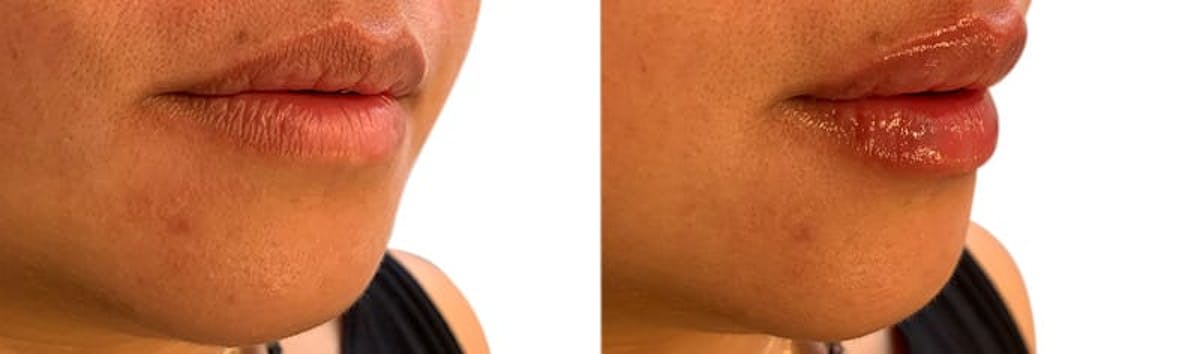 Lip Enhancement Before & After Gallery - Patient 330790 - Image 2