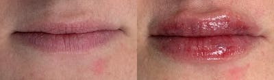 Lip Enhancement Before & After Gallery - Patient 165129 - Image 1