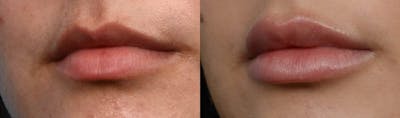 Lip Enhancement Before & After Gallery - Patient 151461 - Image 1