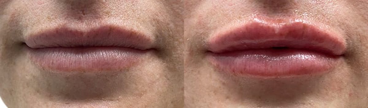 Lip Enhancement Before & After Gallery - Patient 167175 - Image 1