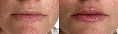 Lip Enhancement Before & After Gallery - Patient 410749 - Image 1