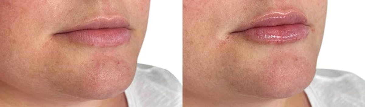 Lip Enhancement Before & After Gallery - Patient 410749 - Image 2