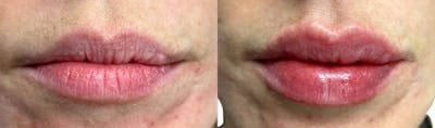 Lip Enhancement Before & After Gallery - Patient 217395 - Image 1
