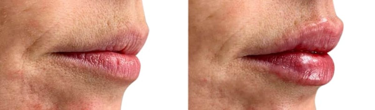 Lip Enhancement Before & After Gallery - Patient 217395 - Image 2