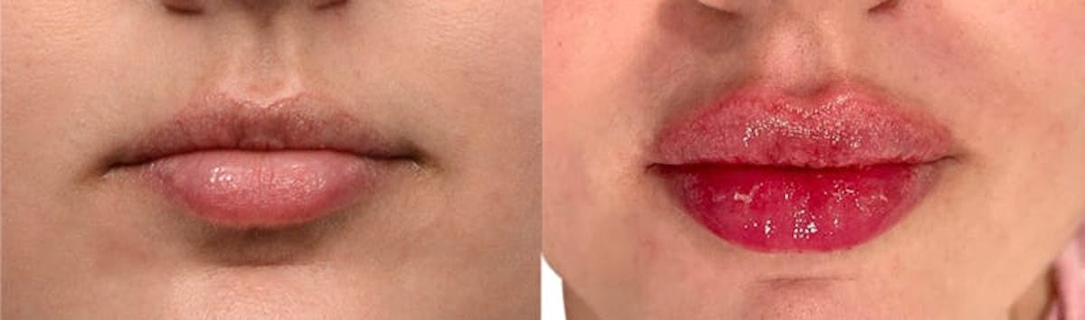 Lip Enhancement Before & After Gallery - Patient 227171 - Image 1