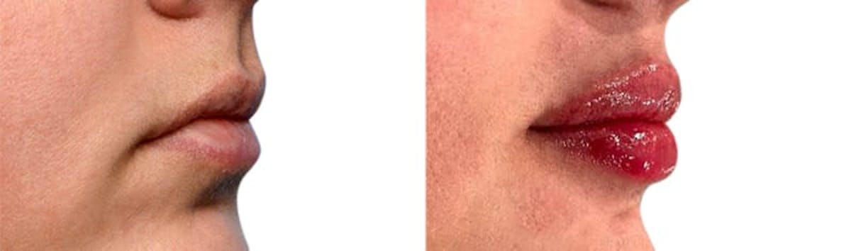 Lip Enhancement Before & After Gallery - Patient 227171 - Image 3