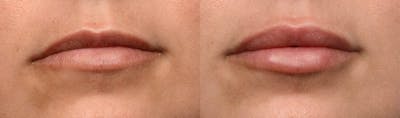 Lip Enhancement Before & After Gallery - Patient 151440 - Image 1