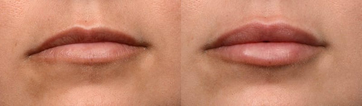 Lip Enhancement Before & After Gallery - Patient 151440 - Image 1