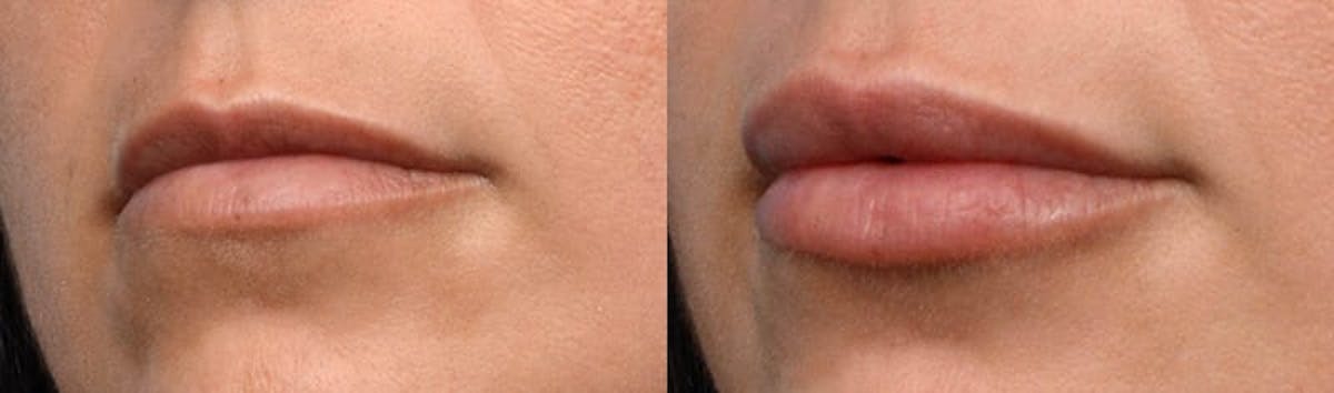 Lip Enhancement Before & After Gallery - Patient 151440 - Image 2