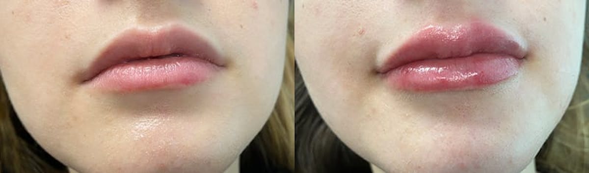 Lip Enhancement Before & After Gallery - Patient 334071 - Image 1