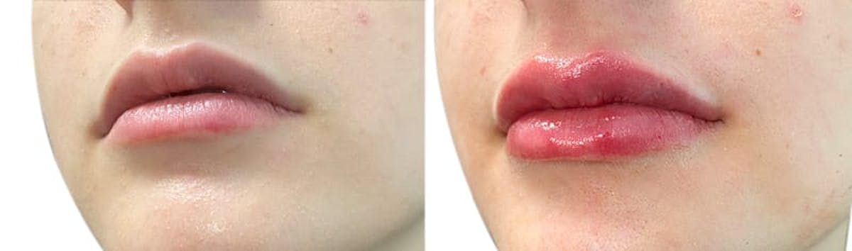 Lip Enhancement Before & After Gallery - Patient 334071 - Image 2