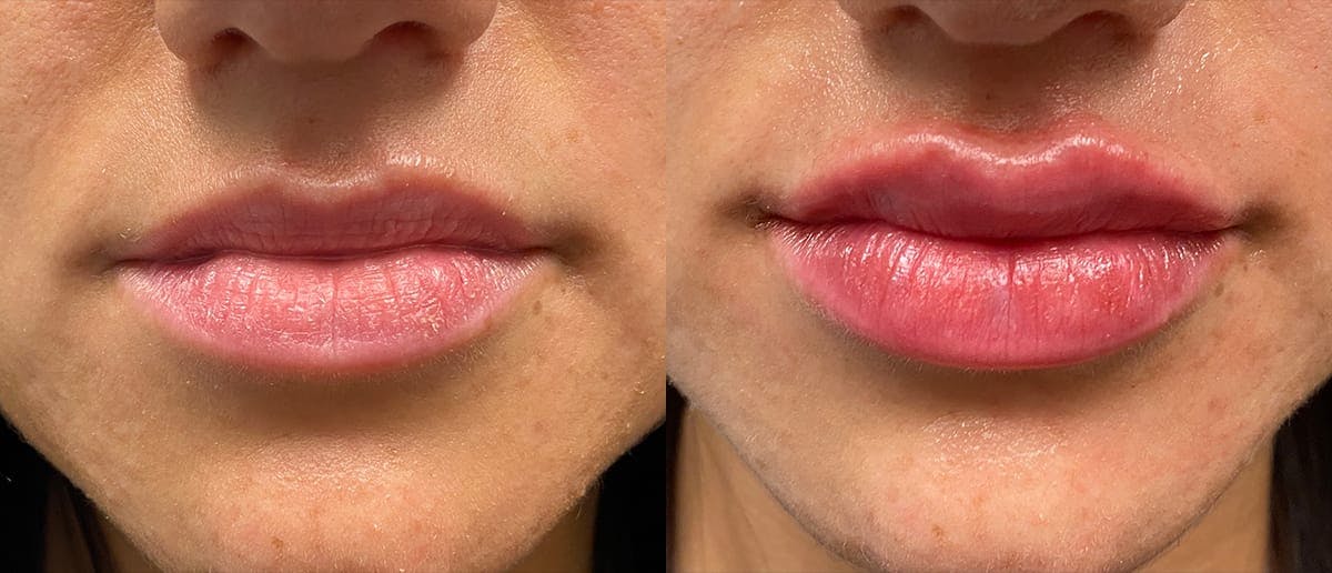 Lip Enhancement Before & After Gallery - Patient 729086 - Image 1