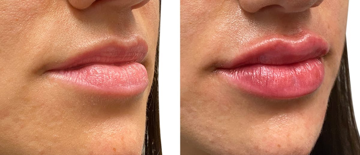 Lip Enhancement Before & After Gallery - Patient 729086 - Image 2