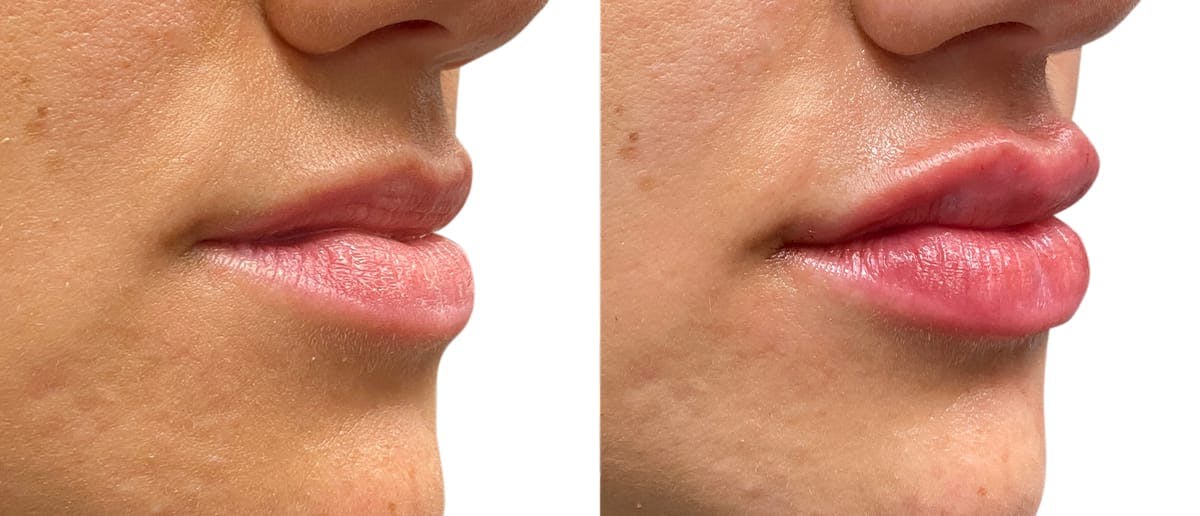 Lip Enhancement Before & After Gallery - Patient 729086 - Image 3