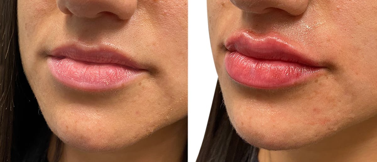 Lip Enhancement Before & After Gallery - Patient 729086 - Image 4