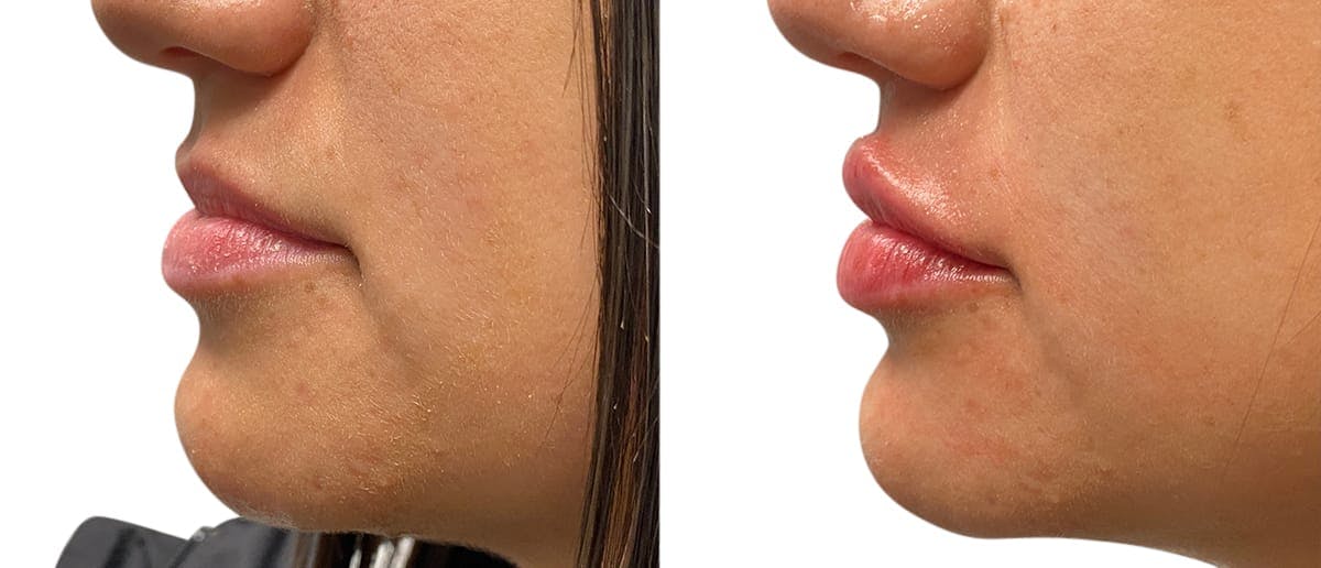 Lip Enhancement Before & After Gallery - Patient 729086 - Image 5