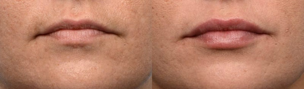 Lip Enhancement Before & After Gallery - Patient 334358 - Image 1