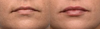 Lip Enhancement Before & After Gallery - Patient 334358 - Image 1