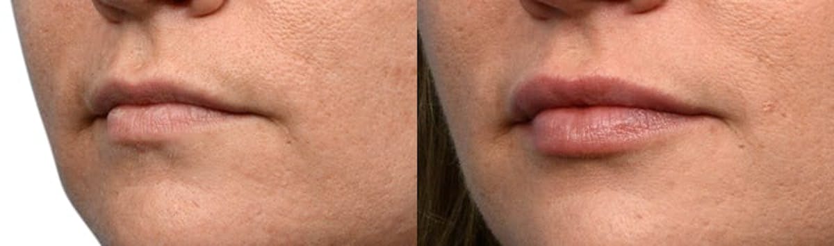 Lip Enhancement Before & After Gallery - Patient 334358 - Image 2