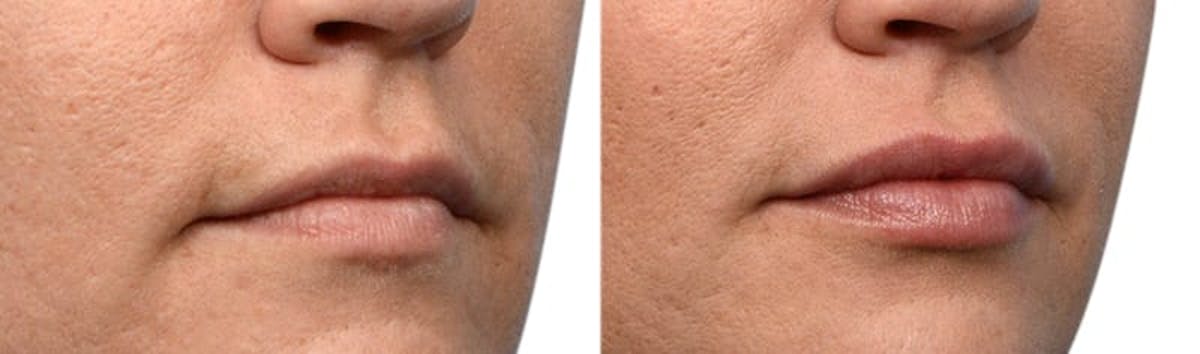 Lip Enhancement Before & After Gallery - Patient 334358 - Image 3