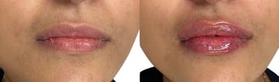 Lip Enhancement Before & After Gallery - Patient 139752 - Image 1