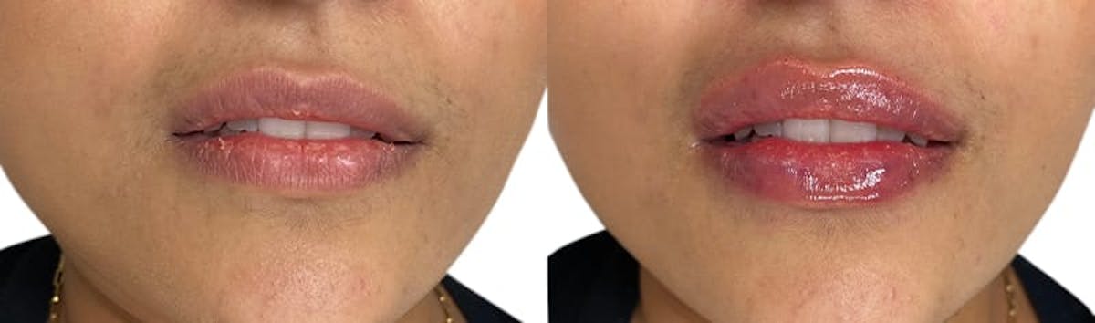Lip Enhancement Before & After Gallery - Patient 139752 - Image 2