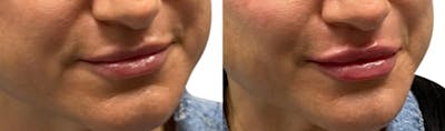 Lip Enhancement Before & After Gallery - Patient 130202 - Image 1