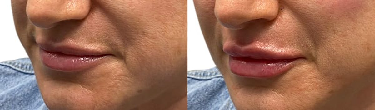Lip Enhancement Before & After Gallery - Patient 130202 - Image 2