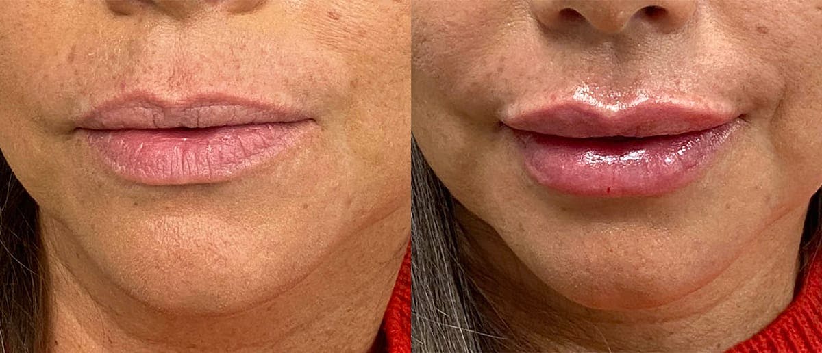 Lip Enhancement Before & After Gallery - Patient 372190 - Image 1