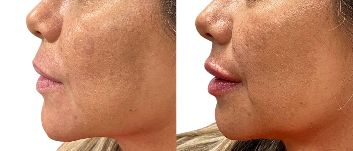 Lip Enhancement Before & After Gallery - Patient 372190 - Image 2
