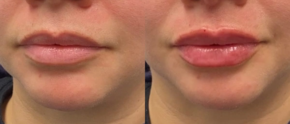 Lip Enhancement Before & After Gallery - Patient 102295 - Image 1