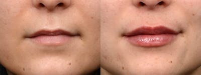 Lip Enhancement Before & After Gallery - Patient 619203 - Image 1